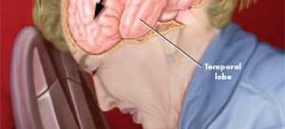 Cerebral Contusion