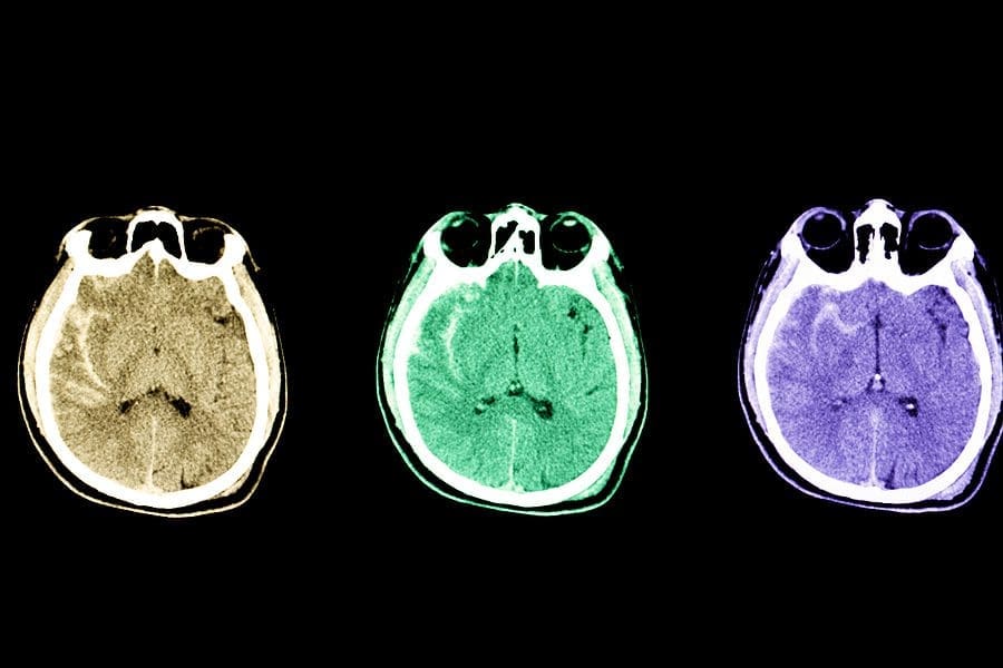 Ct Brain Of A Patient With Traumatic Brain Injury